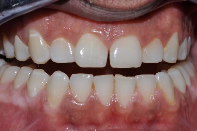before porcelain veneers